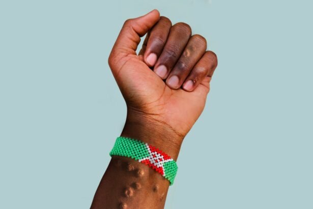 Burundi’s Mpox Crisis A Growing Concern Across the Region