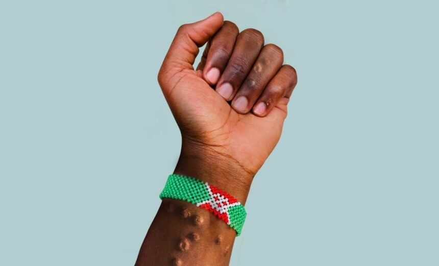 Burundis Mpox Crisis A Growing Concern Across the Region - Africalix Burundi’s Mpox Crisis A Growing Concern Across the Region