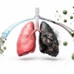 Across Africa, TB Remains a Disease of Inequality and Missed Progress